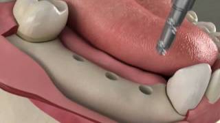 Dental Implants  Implant bridge in Denville NJ [upl. by Hamner]