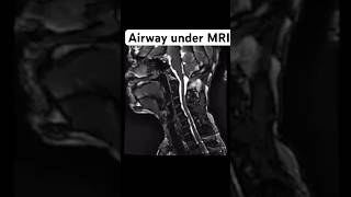 Airway manipulation under MRI anesthesia ytshort shorts [upl. by Rikahs]