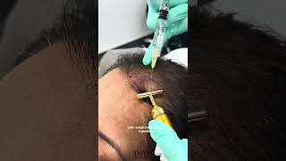 Struggling with Hair Loss Watch How to Regrow hairloss [upl. by Nyleikcaj]