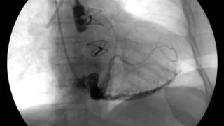 Incorrect placement of CS Catheter shown by fluoroscopy [upl. by Manthei]