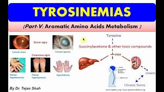 Tyrosinemias II Inborn errors of Aromatic Amino Acids Metabolism II Biochemistry II Dr Tejas Shah [upl. by Guod]