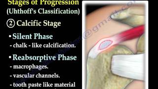 Calcific Tendonitis  Everything You Need To Know  Dr Nabil Ebraheim [upl. by Acnayb216]