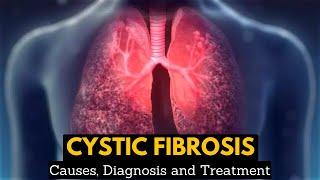 CYSTIC FIBROSIS Causes Signs and Symptoms Diagnosis and Treatment [upl. by Elinnet705]