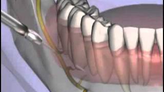 Malameds Local Anesthesia 11 Supplemental Injection Techniques [upl. by Skardol67]