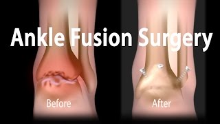 Ankle Fusion Surgery Animation [upl. by Aniahs39]