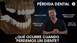 ¿Qué ocurre cuando perdemos un diente 🦷 [upl. by Eppes]