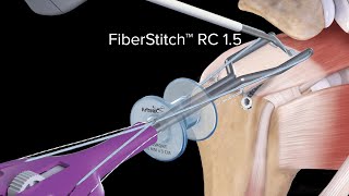 CuffMend™ Augmented Rotator Cuff Repair With FiberStitch™ RC Implant [upl. by Vitus]