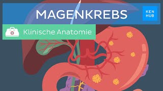 Magenkrebs Ursachen Symptome Diagnose Prognose  Kenhub [upl. by Rosen]