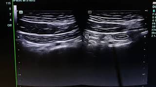 Normal Vs Inflamed Appendix Sonography [upl. by Horlacher]