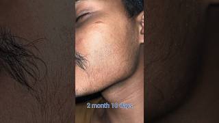 minoxidil minoxidil beard growth  2 month minoxidil beard  mintop [upl. by Avi]