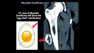 Myositis Ossificans  Everything You Need To Know  Dr Nabil Ebraheim [upl. by Kidd]