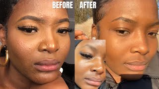 HOW I CLEARD UP MY MALASSEZIAFUNGAL ACNE daily skincare routine [upl. by Jola]