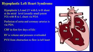 19 Congenital heart disease causing pulmonary venous hypertension and CHD with normal vascularity [upl. by Briant298]