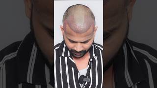 Shedding phase After Hair Transplant shorts 75 hairstyle [upl. by Yug]