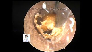 Ear wax removal 20220505 [upl. by Eimaral875]