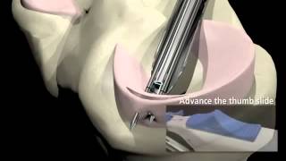 Arthroscopic Meniscus Repair [upl. by Norrag916]