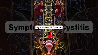 Symptoms of Cystitis cystitis health healthtips shorts [upl. by Ainitsirk275]