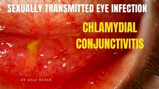 Chlamydial Conjunctivitis Sexually Transmitted Eye Infection Dr Shaz Rehan 2023 [upl. by Sandye]