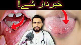 Mouth Ulcers or Canker Sore and Mouth Cancer Awareness in Pashto by Dr Mustaqeem [upl. by Yatnoed926]