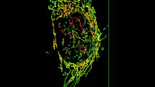 Video Captures Living Cancer Cell [upl. by Intosh]