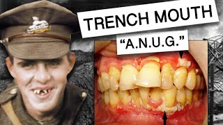 Acute Necrotizing Ulcerative Gingivitis AKA TRENCH MOUTH [upl. by Douglass]