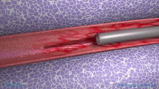 Peripheral IV Phlebitis Animation [upl. by Ethel405]