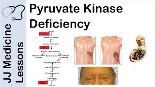 Pyruvate Kinase Deficiency  Symptoms Pathophysiology and Treatment [upl. by Anelyak708]