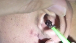 Mans Dark Giant Earwax Removal [upl. by Aneloaup]