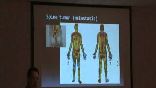 Brioschi  Thermal Imaging Sympathetic Pain and Fibromyalgia Part 1 [upl. by Kutzer87]