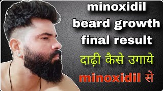 minoxidil beard growth final result  beard kaise ugaye [upl. by Inman]