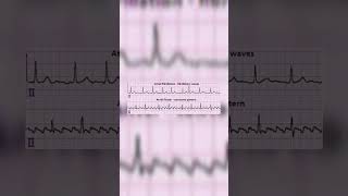 Atrial fibrillation vs Atrial flutter  Medicos  Cardiology [upl. by Linnell]