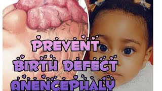 Anencephaly Birth defect explained How to prevent it 2 [upl. by Attennaej]