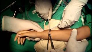 Radio Ulnar Synostosis Treatment at Nagpur India [upl. by Rasmussen]