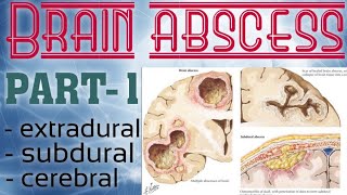 BRAIN ABSCESS  PART1  EXTRA OR EPIDURAL ABSCESS SUBDURAL ABSCESS amp CEREBRAL ABSCESS  NEURO [upl. by Killie]