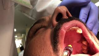 Palatal Anesthetic Infiltration Technique [upl. by Milburn]