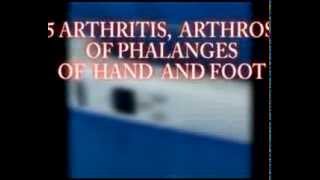 15 ARTHRITIS ARTHROSIS OF PHALANGES OF HAND AND FOOT [upl. by Ecyrb602]