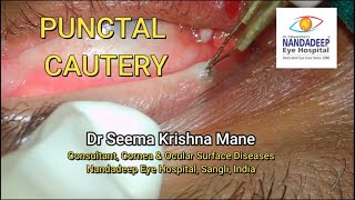 How to do Punctal cautery  Dr Seema Mane Indications and procedure [upl. by Atnwahs]