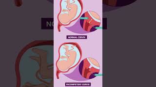 Short cervix during pregnancy 🫄Understanding Cervical Insufficiency pregnant September 8 2024 [upl. by Attenov]