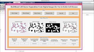 MATLAB Code of Sickle Cell Disease Detection using Red Blood Cell Cluster Separation [upl. by Peale827]