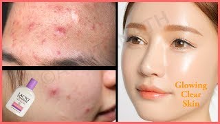 How to Get Rid of Pimples Acne Skin Rashes Prickly Heat Overnight  Lacto Calamine Benefits [upl. by Keeley]