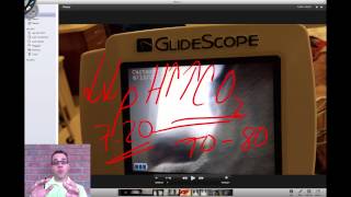 Glidescope intubation and annotation [upl. by Niwrek396]