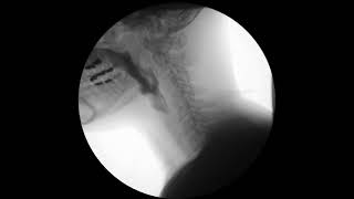 Modified Barium Swallow MBS or VFSS [upl. by Grekin321]