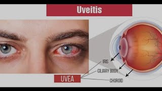 what the uveitis is [upl. by Banyaz]