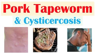 Pork Tapeworm Taeniasis  How It Infects Symptoms amp Cysticercosis Diagnosis Treatment [upl. by Atikam387]