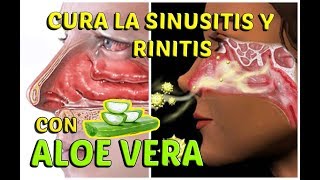 CÓMO CURAR LA SINUSITIS Y RINITIS ALÉRGICA CON ALOE VERA  LifeStyle [upl. by Magocsi]