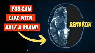 How can the Brain RECOVER from Trauma  Brain Plasticity amp Functional Recovery [upl. by Ynohtnanhoj]