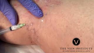 More Sclerotherapy Treatment for Spider Veins [upl. by Novla]