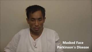 Masked Face in Parkinsons Disease  Dr Paresh Doshi [upl. by Wojcik]