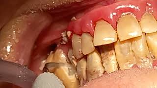 Very satisfying scaling in patient with periodontopathy first part [upl. by Necyla]