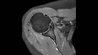 Tear of the posterior glenoid labrum and paralabral cyst [upl. by Roselane]